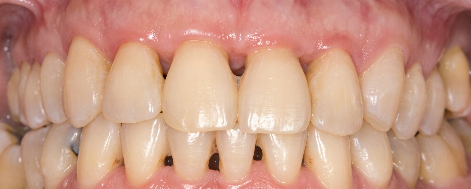 Milieu de la mâchoire supérieure d'un visage