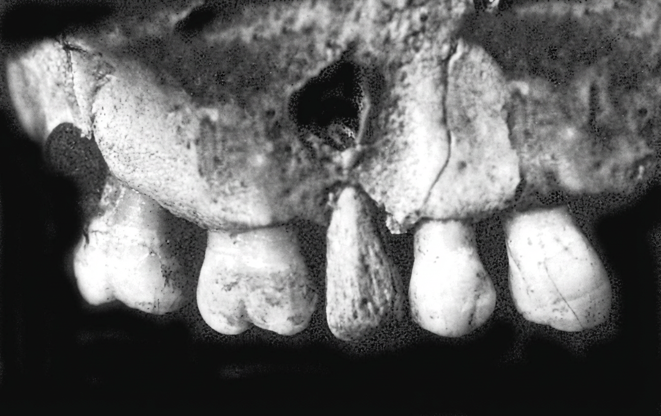 Vue rapprochée de la perforation