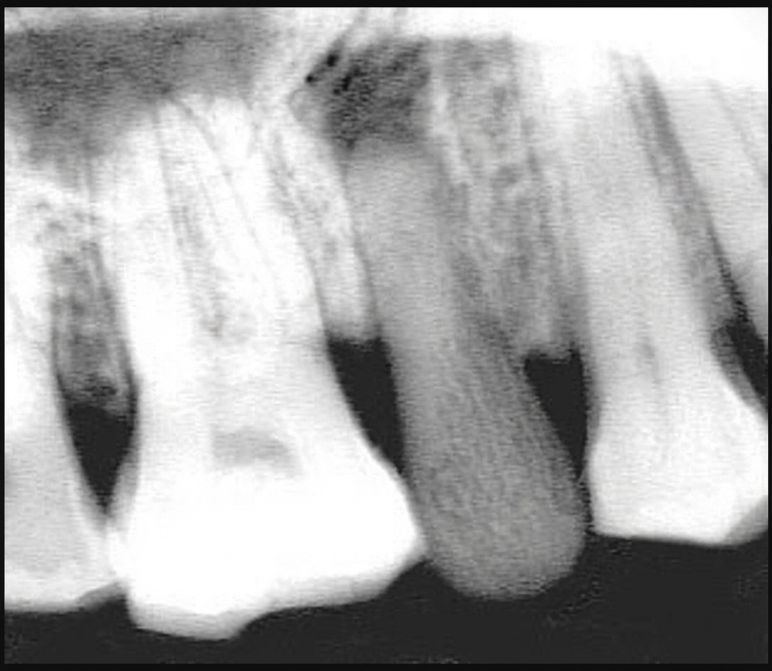 Confirmation radiologique de l’infection au niveau de la dent artificielle