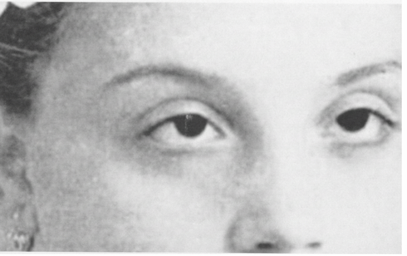 Gemma Di Giorgi enfant: l'œil vitreux sans pupille