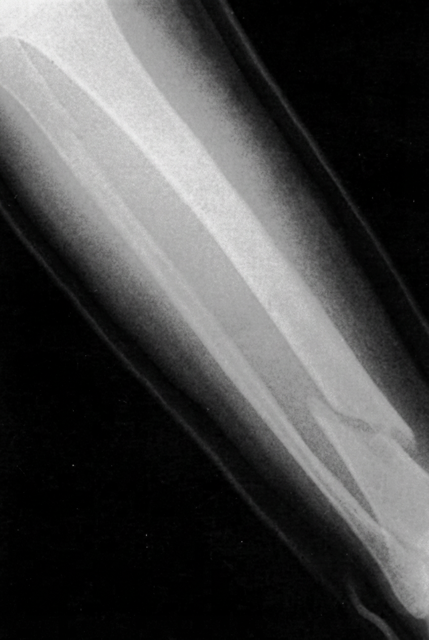 Radiographie d'un os de jambe humaine